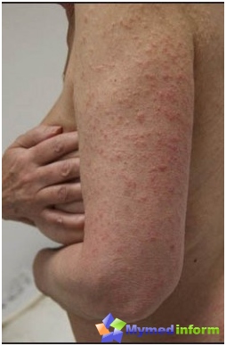 sol allergi symptom sol allergi symptom