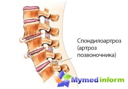Enfermedad espinal, columna vertebral, giro, espondiltrosis, articulaciones