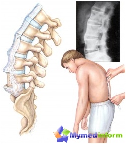Malattia di Bekhterev, tipi di spondilite, colonna vertebrale, spondilite