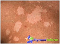 Pityriasis versicolor versicolor