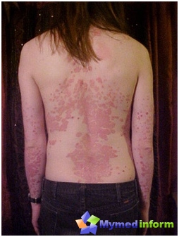 Psoriasis