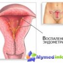 treatment-endometritis