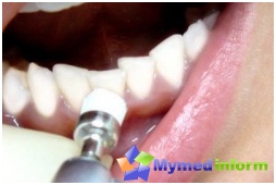 Gingivitis, teeth, treatment of gingivitis, dentistry