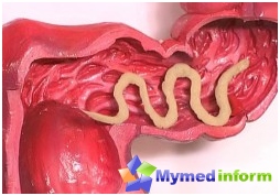 Helminte, tractul gastro-intestinal, intestine, paraziți, tricocefaloză