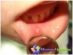 Diagnostica in lingua, bocca, cavità della bocca, ulcera, ulcere linguistiche, lingua