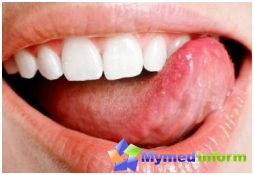 Diagnóstico na linguagem, boca, cavidade da boca, úlcera, Úlceras de linguagem, linguagem