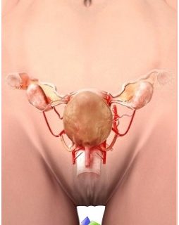 uterine-artery-embolization