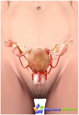 Gynekologi, kvinnliga sjukdomar, kvinna, livmoder, embolisering av livmoderartärer
