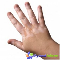 vitiligo, vitiligo u dětí, dermatologie, dětská onemocnění, kůže, kožní choroby, pigmentace