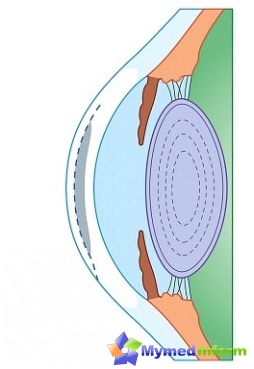 Myopia, oczy, wzrok, krótkowzroczność, okulistyka