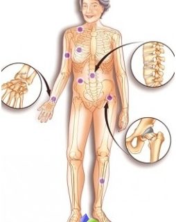 what-osteoporosis