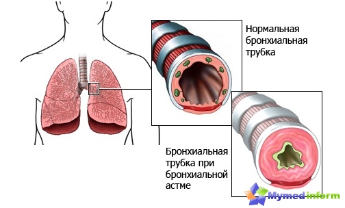 Asma brônquica