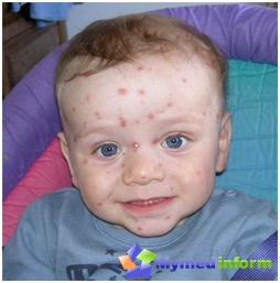 You can infected the chickenpox virus from a person to man with air-droplet