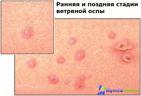 Manifestation of chickenpox at different stages