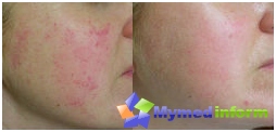 Rosacea-Behandlung