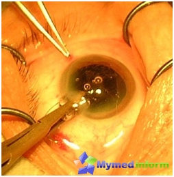 Operation on glaucoma