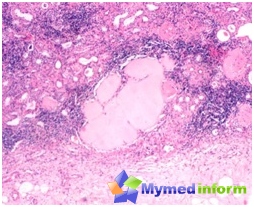 Pielonefritis crónica