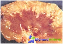 Kidney damage pyelonephritis