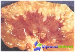 Pielonefritis de daño renal