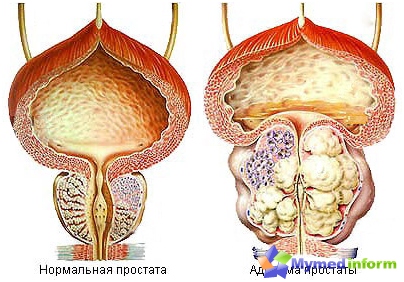 Adenoma prostate (prostata)