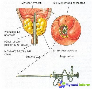 Rispersoroscopio (resktocistoscopio) utilizzato per tagliare il tessuto della prostata durante la resezione transsuretral