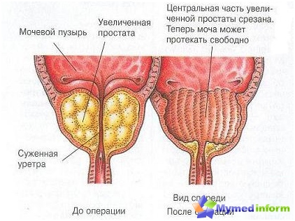 Prostata prima e dopo la resezione transgente