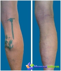 Operations in varicose veins: up (left) and after (reference) operations