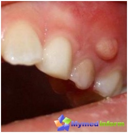 Granuloma, zub, zubobolja, cista, zub cista, tumor, stomatologija