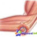 epikondilit-elbow-joint