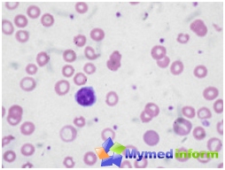 Imagen histológica de la sangre, con anemia de deficiencia de hierro