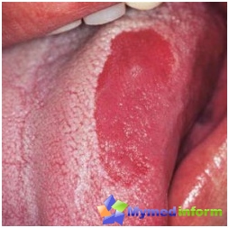 Entzündung, Glossitis, Zahnheilkunde, Zunge