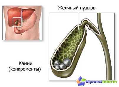 Žlučníkové onemocnění (GSD) - onemocnění, při kterém se ve žlučníku tvoří kameny (kameny), sestávající z žlučových solí, cholesterolu a barviva - bilirubinu