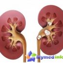 kidney-stones-folk-remedies