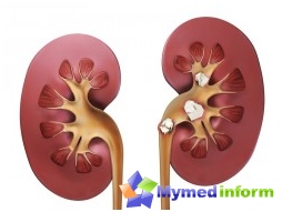 Stones in the kidneys, urolithiasis, traditional medicine, kidneys, urology