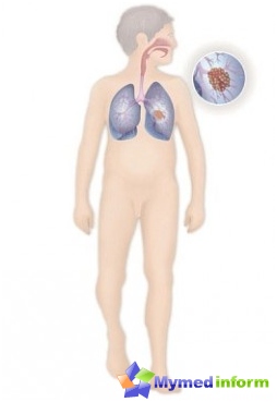 Bronquios, enfermedades de los bronquios, enfermedades pulmonares, pulmones