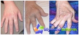 Arthritis damaged hands