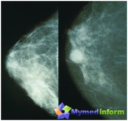 Нормална гърда (вляво) и рак на гърдата (вдясно) при мамография