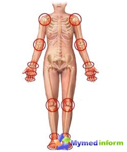 Leddene oftest ramt af arthritis