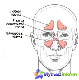 Es lohnt sich nicht, mit einer laufenden Nase zu beginnen, damit sich die Entzündung nicht auf den Oberkiefer, die Stirnhöhlen und andere Bereiche ausbreitet