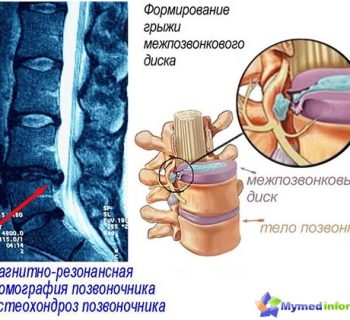 osteochondrosis