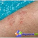psoriasis-symptoms-and-treatment
