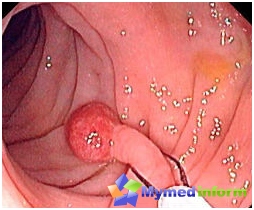 Polyps a gyomorban, fajokban és kezelésben