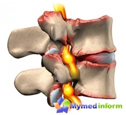 Dolor de espalda, enfermedades de la columna vertebral, columna vertebral, protrusión, protrusión de discos intervertebrales, girar
