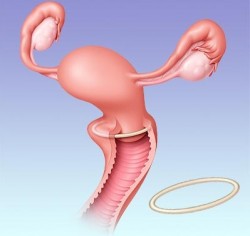Tipos de contracepção, contracepção hormonal, contracepção, gravidez indesejada, anel contraceptivo