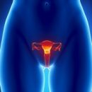 fibromioma-uterus
