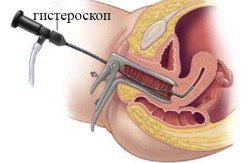 Gynécologie, hystéroscopie utérus, maladies féminines, santé féminine, utérus