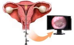 Gynekologi, livmoderhysteroskopi, kvinnliga sjukdomar, kvinnlig hälsa, livmoder