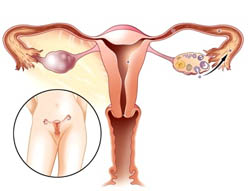 Chisturile ovariene, simptomele și metodele de tratament