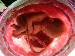 Gravidez, útero, complicações para parto, descontinuação da placenta, placenta