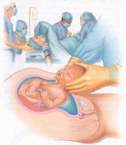cesarean